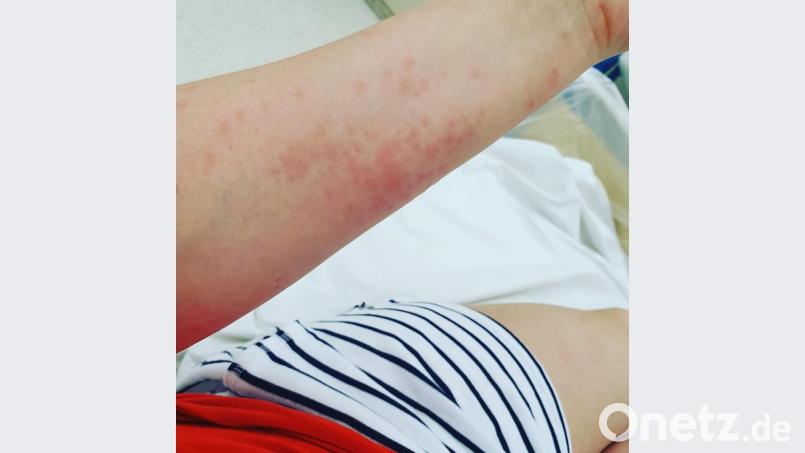 Der Ausschlag auf dem Arm von Simone Dehling nach dem Kontakt mit den Härchen des Eichenprozessionsspinners. Bild: Dehling