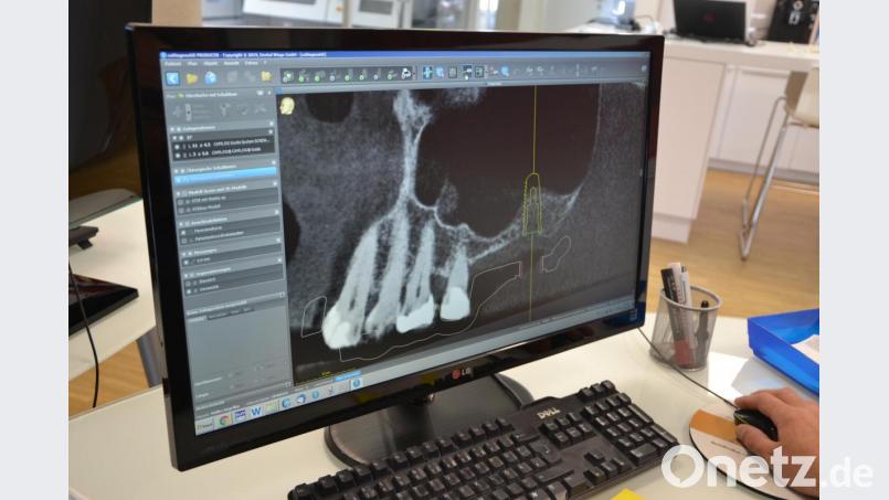 Werden Gebiss und Kiefer eines Patienten beim Zahnarzt dreidimensional erfasst (zum Beispiel per Computertomographie oder sogenannter Volumentomographie), lässt sich am Bildschirm genau ermitteln, wie Implantante gesetzt werden müssen. Bild: Reiner Wittmann