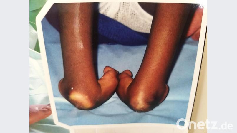 So haben Peters Klumpfüße im Jahr 2003 vor den Operationen ausgesehen. Bild: exb