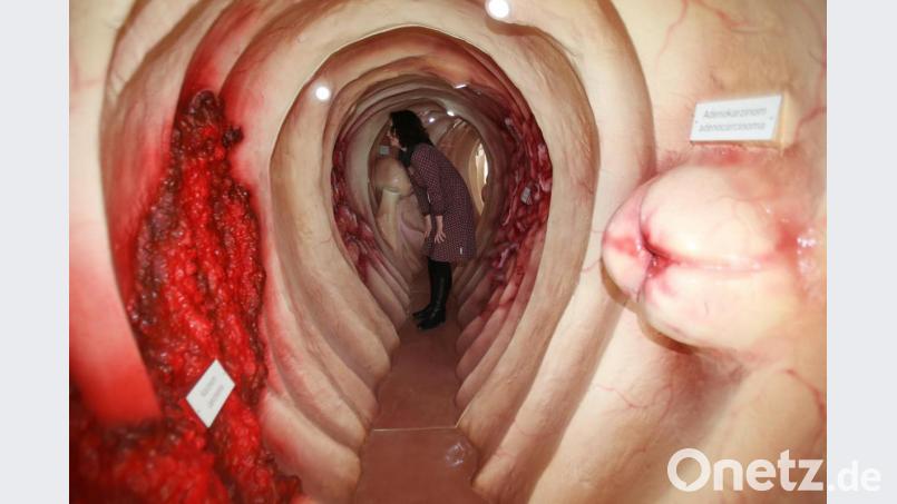 Ein begehbares Darm-Modell zeigt verschiedene Arten von Darmkrankheiten Symbolbild: Bodo Schackow