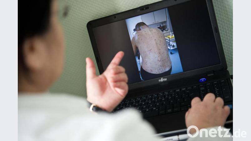 Skabies, also Krätze, ist eine Hautkrankheit, die durch eine Milbe hervorgerufen wird. Symbolbild: Daniel Naupold/dpa