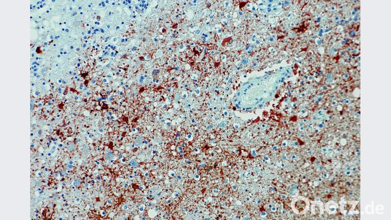Anitkörpernachweis zum Borna-Virus im Gewebe. Foto: Bernhard-Nocht-Institut für Tropenmedizin/dpa