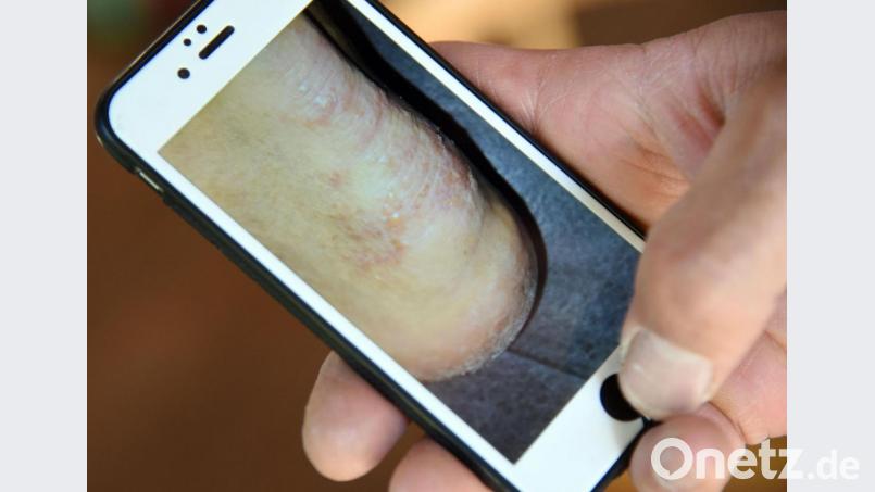 Krätze in Weiden? Der Vorsitzender des Vereins Handwerkerhaus glaubt an einen Lausbubenstreich. Symbolbild: Henning Kaiser