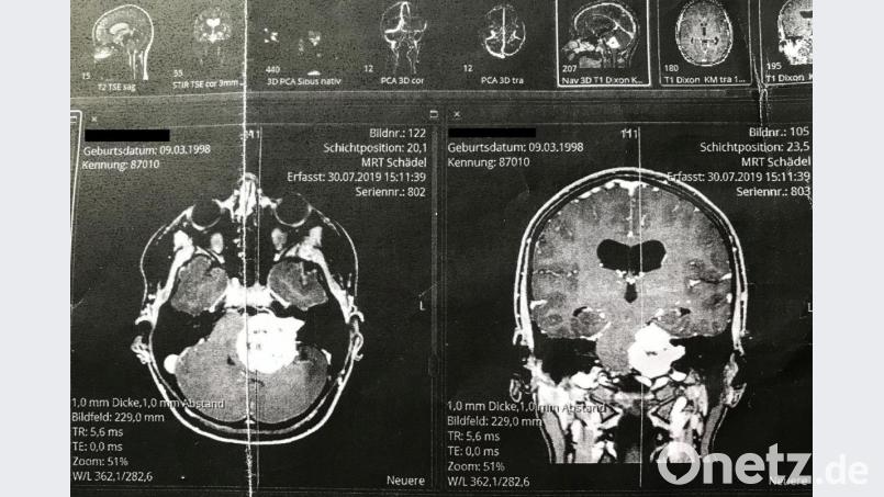 Das MRT zeigt einen großen weißen Fleck: Das ist der gigantische Tumor im Schädel von Elisabeth Schwarz. Bild: Klinikum Weiden