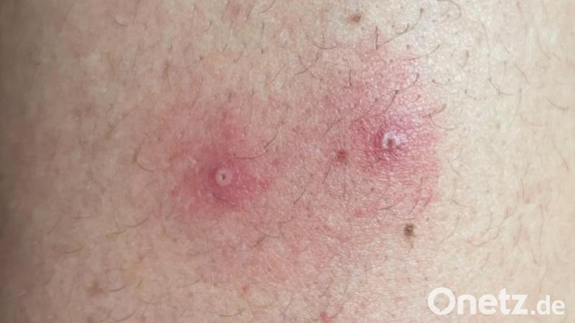 Das vom Institute of Tropical Medicine Antwerp zur Verfügung gestellte Foto zeigt Hautsymptome von Affenpocken-Patienten Archivbild: Institute of Tropical Medicine, Antwerp/dpa