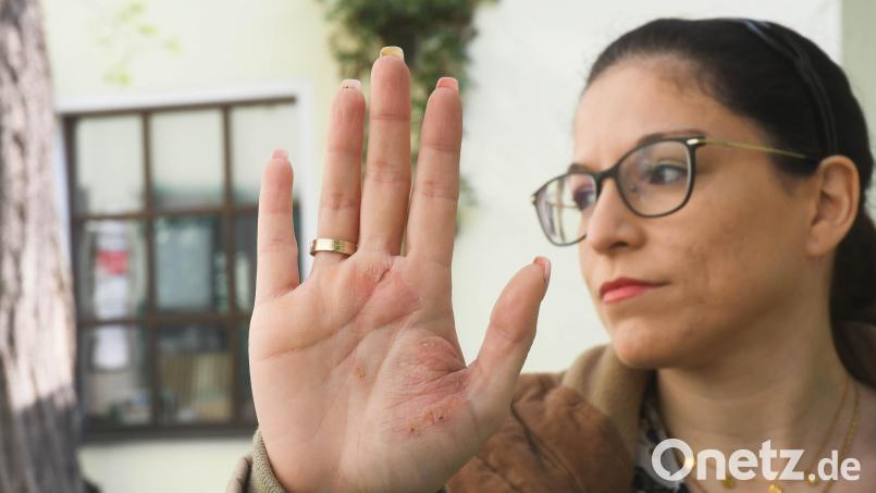 Juliane Meier zeigt ihre rechte Hand. Sie sagt, die Entzündung dort sei nach der Corona-Impfung aufgetreten. Bild: Gabi Schönberger