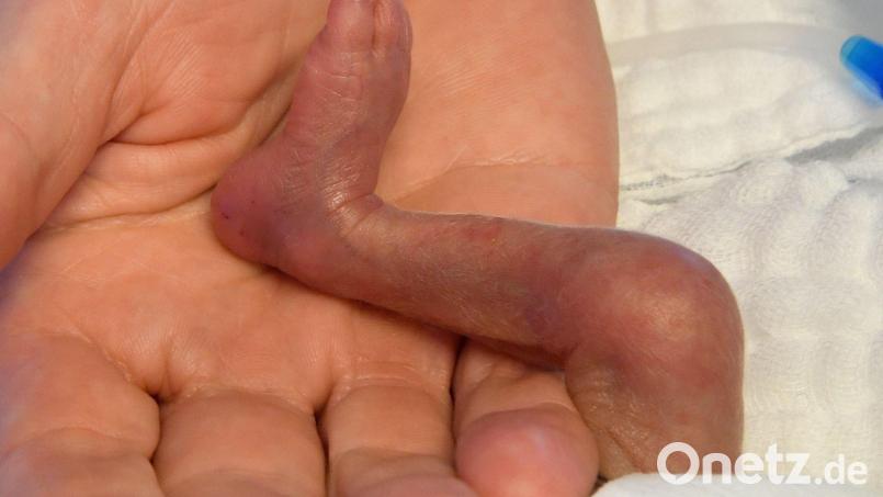 Risikoschwangere und extrem Frühgeborene aus der Region werden vorrangig im Klinikum Amberg versorgt. Symbolbild: Holger Hollemann