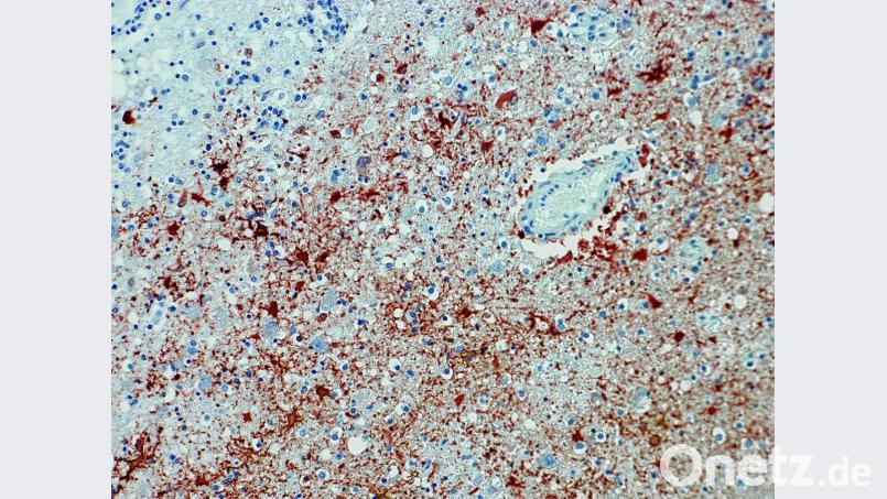 Die undatierte Aufnahme zeigt einen Anitkörpernachweis zum Borna-Virus im Gewebe. Bild: Bernhard-Nocht-Institut für Tropenmedizin/dpa
