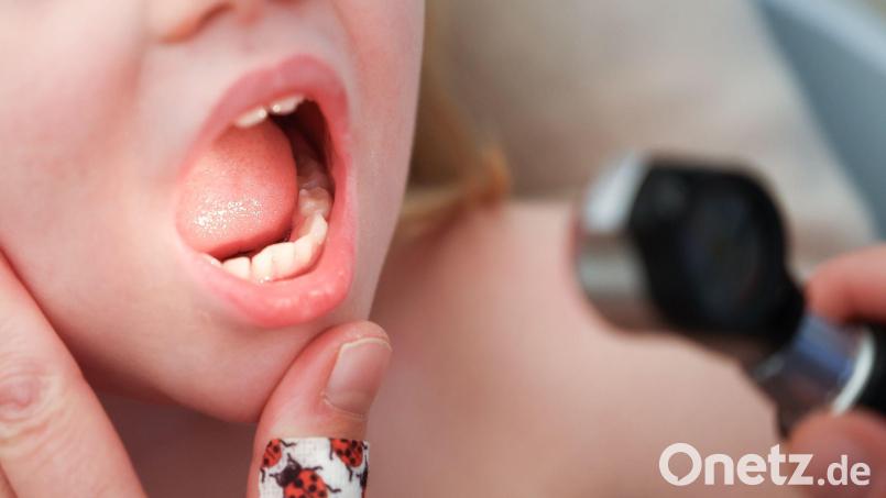 Bitte mal &quot;Aaaa&quot; sagen! Die derzeitige Influenzawelle bringt vor allem Kinderarztpraxen in ihr Limit. Symbolbild: Christian Charisius/dpa