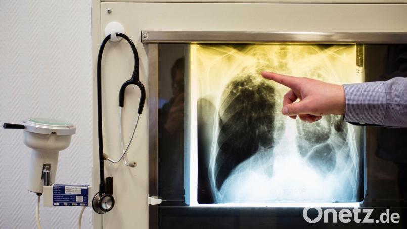 Tuberkulose-Erkrankungen werden in Europa oft nicht erkannt. (Illustration) Bild: Gregor Fischer/Deutsche Presse-Agentur GmbH/dpa