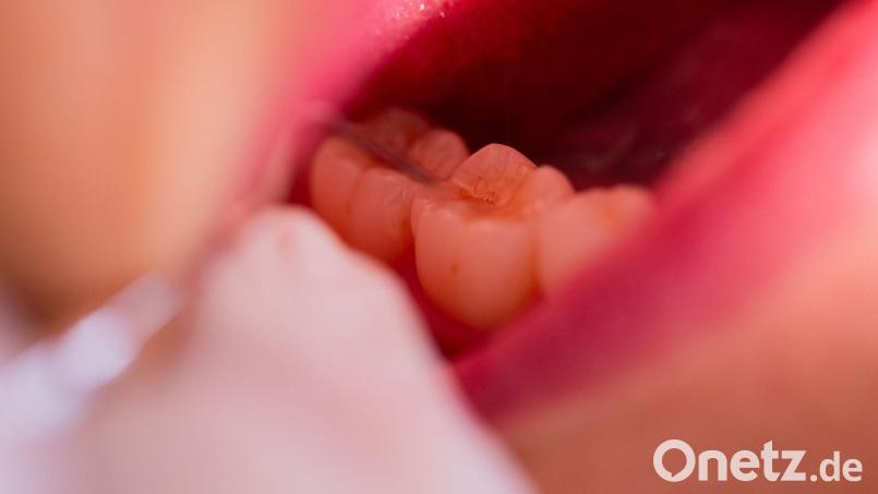 Nach einer Behandlung in einer Augsburger Zahnarztpraxis ist ein Patient gestorben. (Symbolbild) Bild: Rolf Vennenbernd/dpa