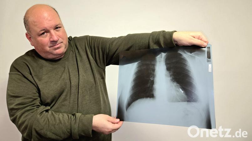Horst Fischer zeigt ein Röntgenbild seines Brustkorbs: Der weiße pilzförmige Bereich rechts unten zwischen den grauen und schwarzen Flächen ist das Gewehrprojektil, das seit 37 Jahren in seiner Lunge steckt. Bild: lnz