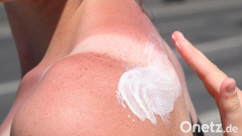 Sonnenbrand ist gefährlich - es drohen Langzeitfolgen. Bild: Stephanie Pilick/dpa/dpa-tmn