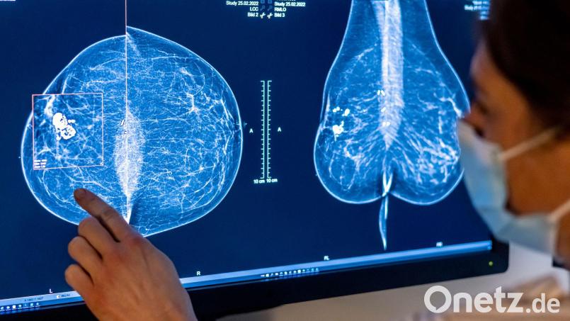 Mit einer Mammografie untersuchen Ärzte die Brust einer Frau auf Brustkrebs - nun gelten geänderte Regeln. (Symbolfoto) Bild: Hannibal Hanschke/dpa