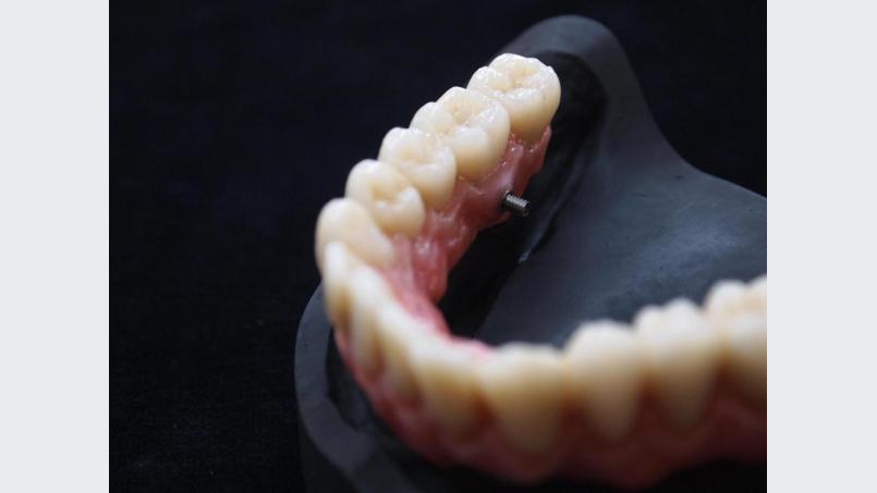 Zahnersatz und Implantate – auch in diesem Bereich hat längst die digitale Technik Einzug gehalten. Und das &quot;dental team&quot; gehört hier zu den führenden Labors deutschlandweit Bild: exb