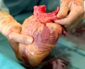 Bild: Bernd Wüstneck/dpa
Ein Transplantationsmediziner hält das Herz eines Verstorbenen in den Händen, das kurz zuvor entnommen wurde. Dem Organ werden später die Herzklappen für Gewebespenden entnommen.