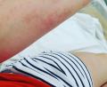 Bild: Dehling
Der Ausschlag auf dem Arm von Simone Dehling nach dem Kontakt mit den Härchen des Eichenprozessionsspinners.