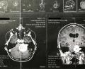 Bild: Klinikum Weiden
Das MRT zeigt einen großen weißen Fleck: Das ist der gigantische Tumor im Schädel von Elisabeth Schwarz.