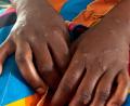 Bild: Janvier Barhahiga/AP/dpa
Mpox ist vor allem für kleine Kinder und immungeschwächte Menschen gefährlich (Archivbild)