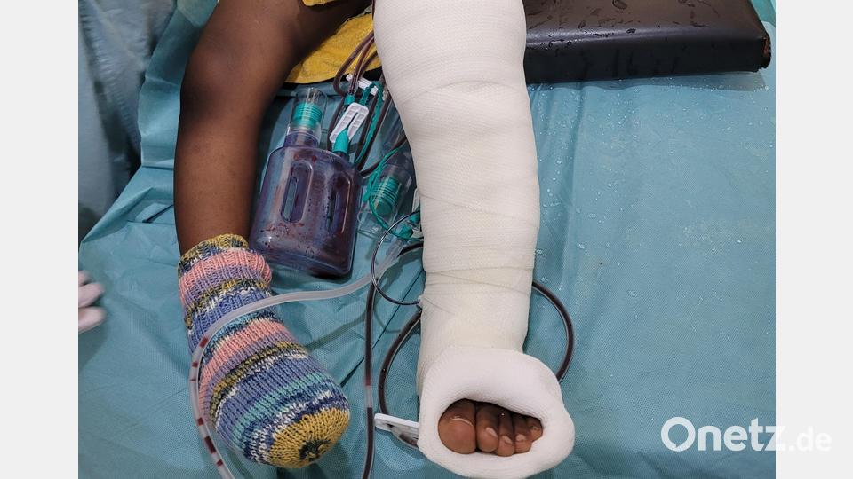 Ein Patient nach der OP. Bild: Aktion Feuerkinder/exb