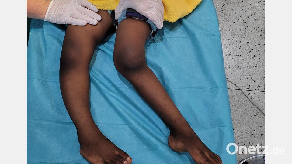 Ein Patient vor der OP. Bild: Aktion Feuerkinder/exb