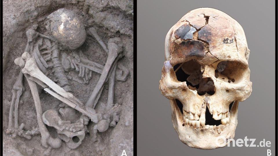 Der Schädel dieses männlichen Fundes ist teilweise verbrannt. Bild: Hirofumi Matsumura; Zhen Li/-/dpa