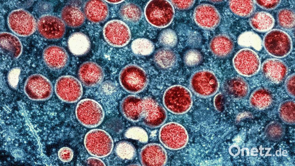Beim Menschen wurden Mpox erstmals 1970 in der Demokratischen Republik Kongo identifiziert (Symbolbild). Bild: -/National Institute of Allergy and Infectious Diseases/dpa