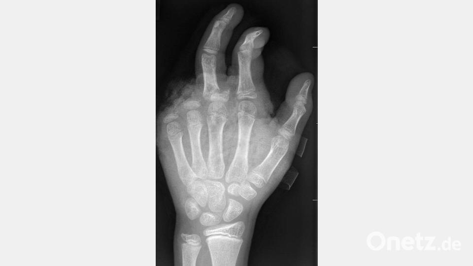 So kann ein Röntgenbild nach einer missglückten Böllerexplosion aussehen: Zwei Finger fehlen. Bild: -/UKB/dpa