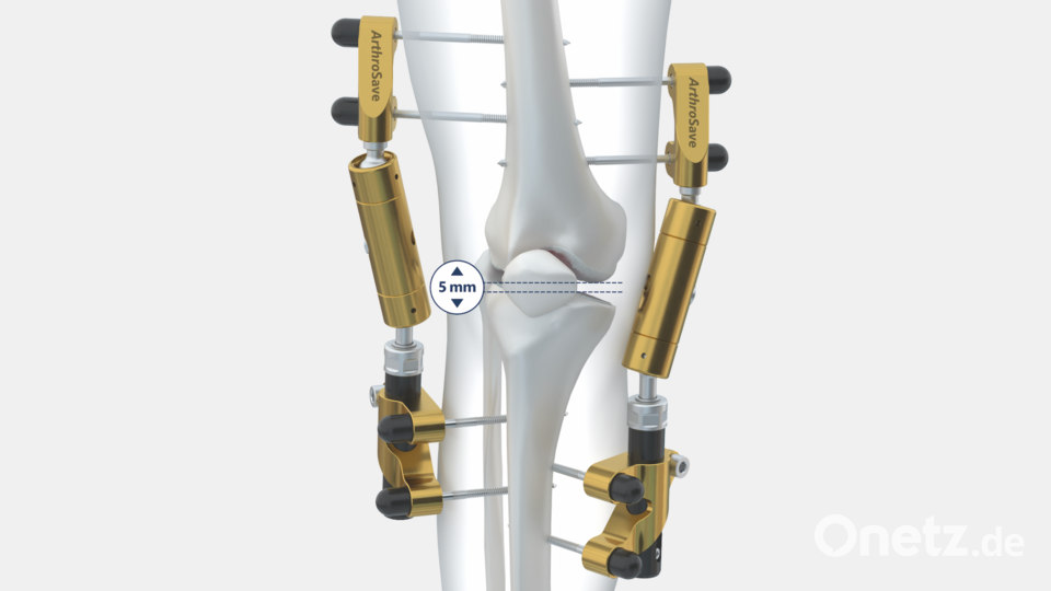 So sieht der Mechanismus aus, der die Selbstheilungskräfte im Knie aktivieren soll. Bild: Paulien van Leeuwen/ArthroSave