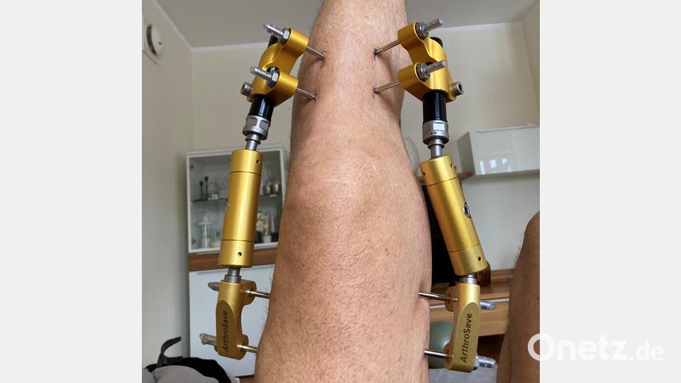 So sieht die Apparatur aus, mit deren Hilfe sich der Knorpel im Knie-Gelenk wie ein Stück abgenutzter Rasen durch Ruhigstellung bei gleichzeitiger Distraktion (kontrolliertes Auseinanderziehen) erholen soll. Bild: Markus Hofmann
