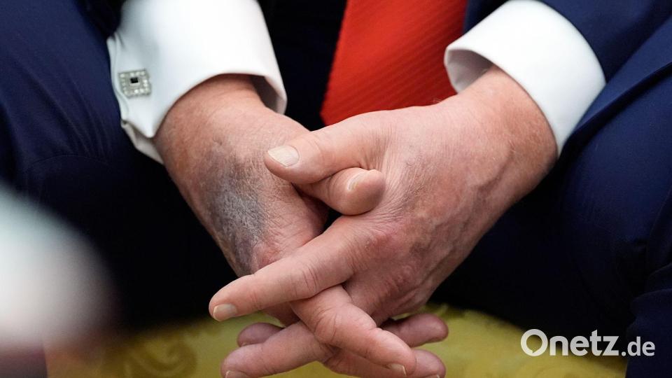 Blaue Flecken geben immer wieder Anlass für Spekulationen. (Archivbild) Bild: Alex Brandon/AP/dpa