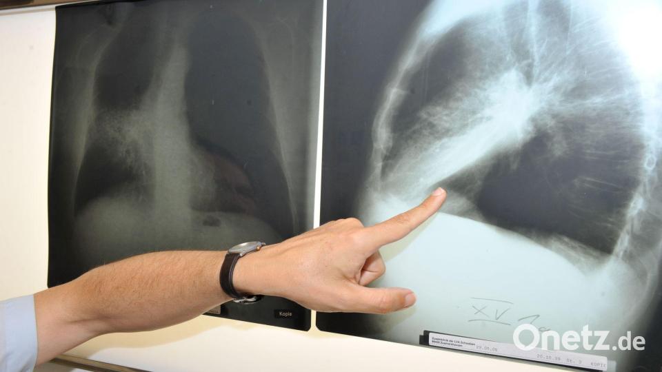 Ein Arzt zeigt auf ein Röntgenbild einer von Krebs befallenen Lunge. Bild: Felix Hörhager/dpa