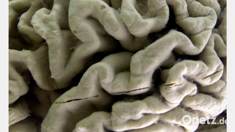Das Gehirn eines Alzheimer-Patienten zeigt tiefe Furchen. (Illustration) Bild: David Duprey/AP/dpa