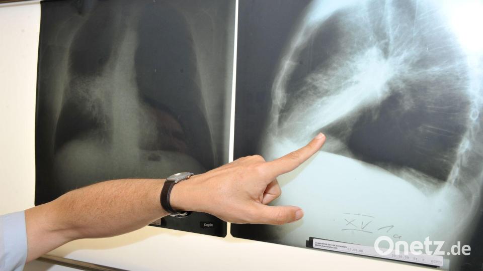 Ab April soll es losgehen mit dem neuen Programm zur Früherkennung von Lungenkrebs. Bild: Felix Hörhager/dpa