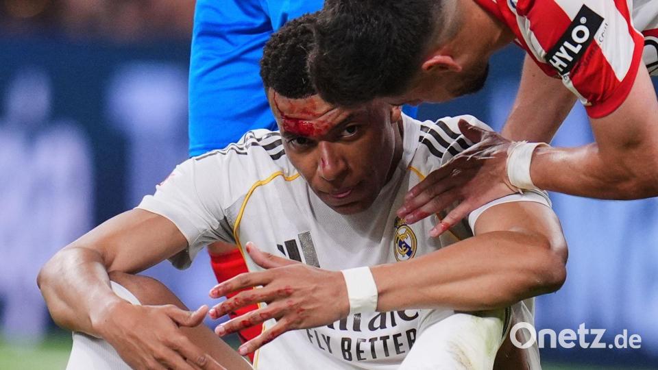 Mbappé wurde im Gesicht getroffen. Bild: Manu Fernandez/AP/dpa