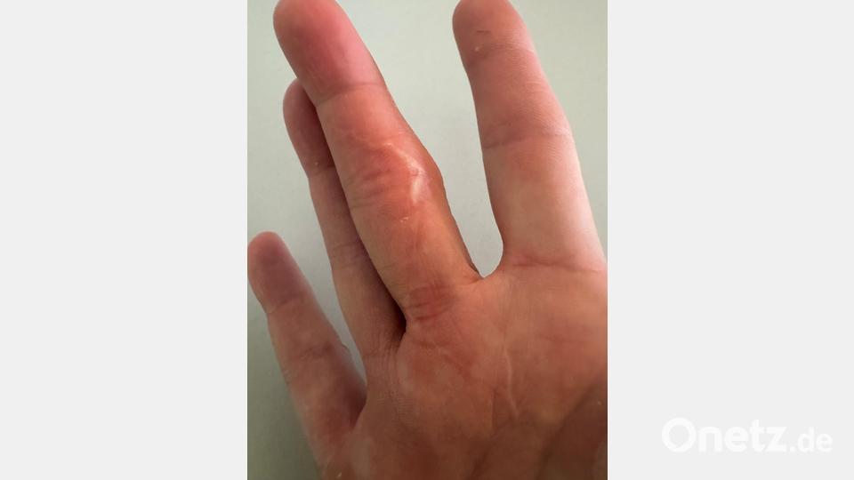 Inzwischen ist alles verheilt. Die zickzackförmige Narbe an ihrem rechten Mittelfinger erinnert Bea Obst für immer daran, was passiert ist. Sie ist nun beim Spielen mit ihrem Kater vorsichtiger. Bild: Bea Obst