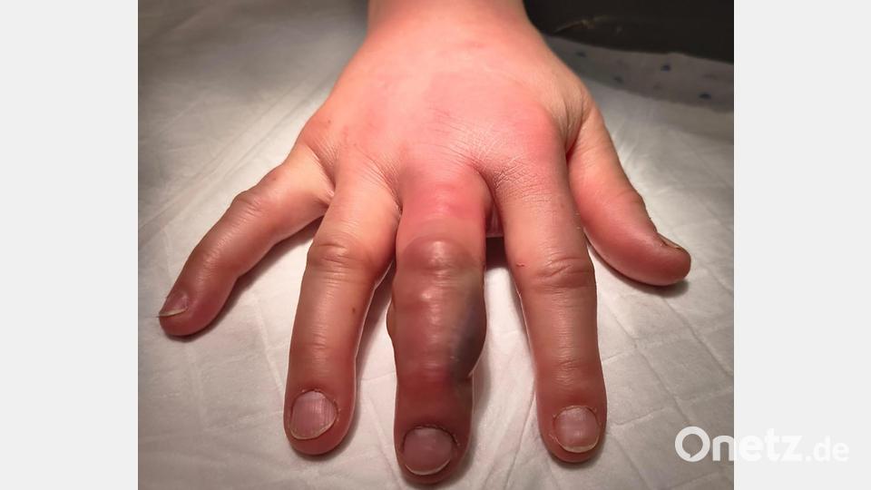 Die Hand von Bea Obst ist trotz der Einnahme eines Antibiotikums gerötet und stark geschwollen. Die Haut an dem verletzten Finger bildet Blasen. Bild: Bea Obst