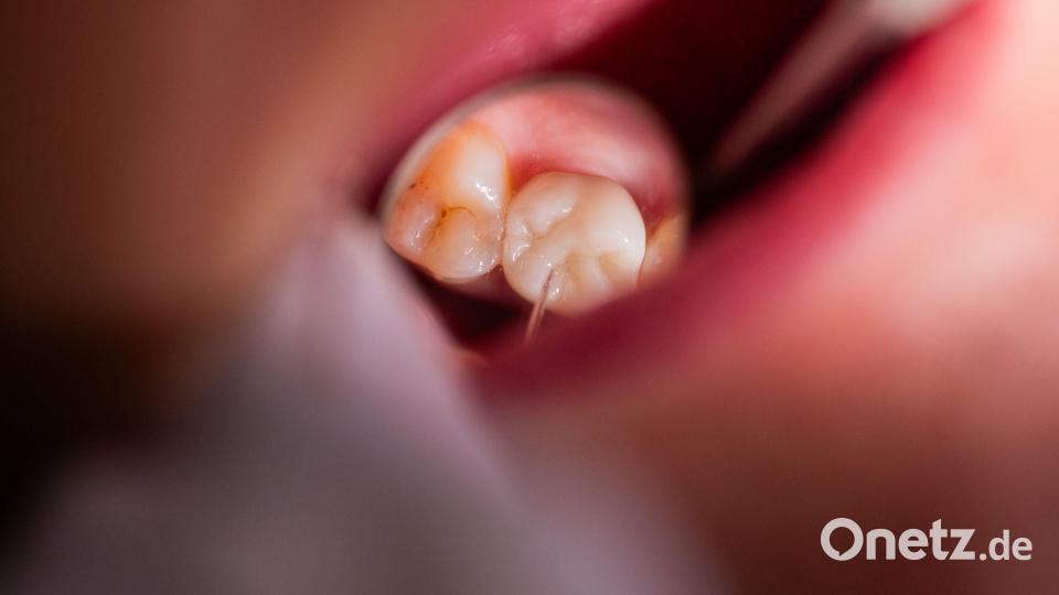 Entzündetes Zahnfleisch oder eine schlechtsitzende Prothese können schlimme Folgen haben. (Symbolbild) Bild: Rolf Vennenbernd/dpa/dpa-tmn