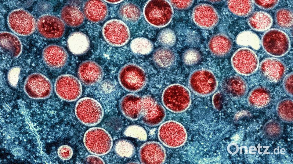 Die eitrigen Pusteln können am ganzen Körper auftreten und sehr schmerzhaft sein. (Symbolbild) Bild: -/National Institute of Allergy and Infectious Diseases/dpa