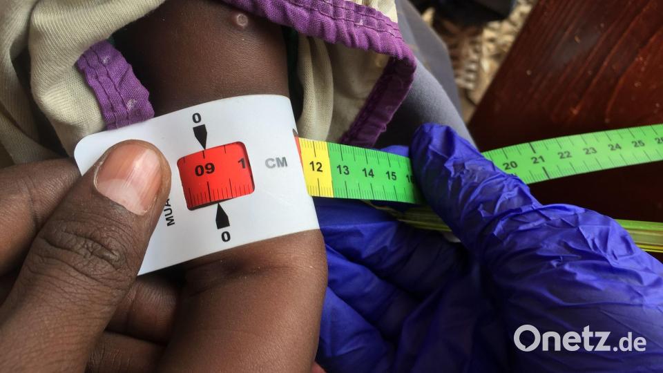 Ein Arzt misst den Armumfang eines unterernährten Babys. Mehr als die Hälfte der Bevölkerung in Somalia ist chronisch unterernährt. (Archivbild) Bild: Eva-Maria Krafczyk/dpa