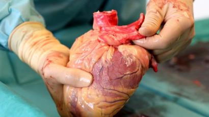 Bild: Bernd Wüstneck/dpa
Ein Transplantationsmediziner hält das Herz eines Verstorbenen in den Händen, das kurz zuvor entnommen wurde. Dem Organ werden später die Herzklappen für Gewebespenden entnommen.