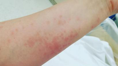 Bild: Dehling
Der Ausschlag auf dem Arm von Simone Dehling nach dem Kontakt mit den Härchen des Eichenprozessionsspinners.