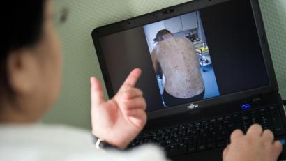 Symbolbild: Daniel Naupold/dpa 
Skabies, also Krätze, ist eine Hautkrankheit, die durch eine Milbe hervorgerufen wird.