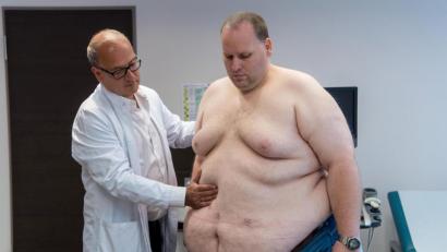 Symbolbild: Boris Roessler/dpa
Vier Wochen, nachdem ihm die Chirurgen einen „Schlauchmagen“ geformt haben, wird ein Patient untersucht. Dabei zeugen kleine Narben auf dem Bauch des Patienten von der Operation.