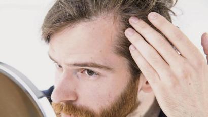 Bild: Christin Klose/dpa
Größer werdende Geheimratsecken können bei Männern auf einen anlagebedingten Haarausfall hindeuten.