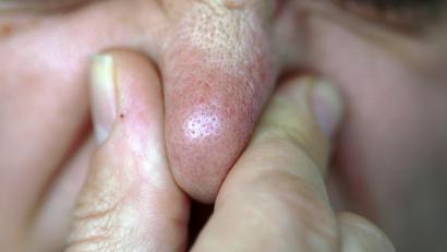 Symbolbild: Oliver Berg
Die Geruchswahrnehmung der Oberpfälzer führte laut Autor Bodo Mrozek in der "Katzendreckgestank"-Affäre zu politischem Handeln auf internationaler Ebene.