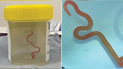 Bild: Emerging Infectious Diseases/AAP/dpa
Das undatiertes Bild zeigt den lebenden Spulwurm „Ophidascaris robertsi“, der im Gehirn einer 64-jährigen Australierin gefunden wurde.