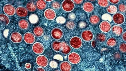 Bild: -/National Institute of Allergy and Infectious Diseases/dpa
Beim Menschen wurden Mpox erstmals 1970 in der Demokratischen Republik Kongo identifiziert (Symbolbild).