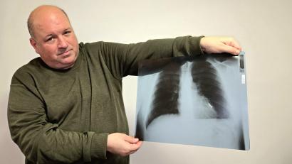 Bild: lnz
Horst Fischer zeigt ein Röntgenbild seines Brustkorbs: Der weiße pilzförmige Bereich rechts unten zwischen den grauen und schwarzen Flächen ist das Gewehrprojektil, das seit 37 Jahren in seiner Lunge steckt.