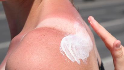 Bild: Stephanie Pilick/dpa/dpa-tmn
Sonnenbrand ist gefährlich - es drohen Langzeitfolgen.
